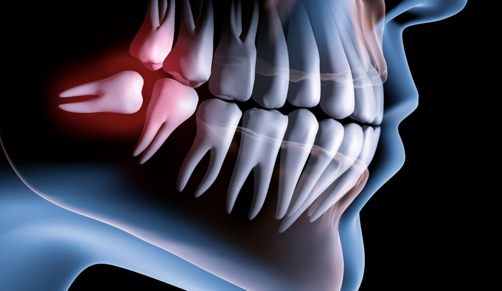 E’ sempre necessario estrarre i denti del giudizio?