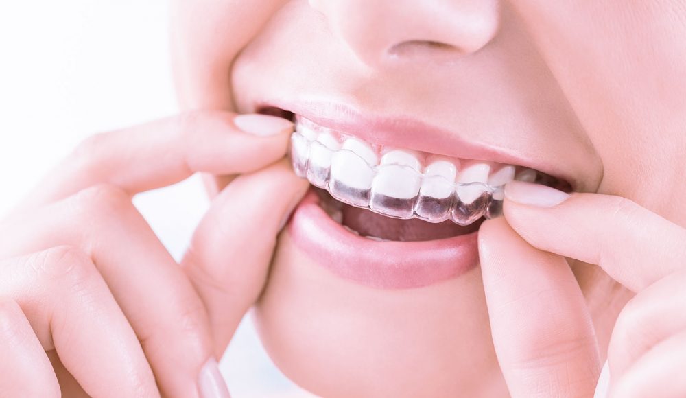 La soluzione migliore per l’allineamento dentale